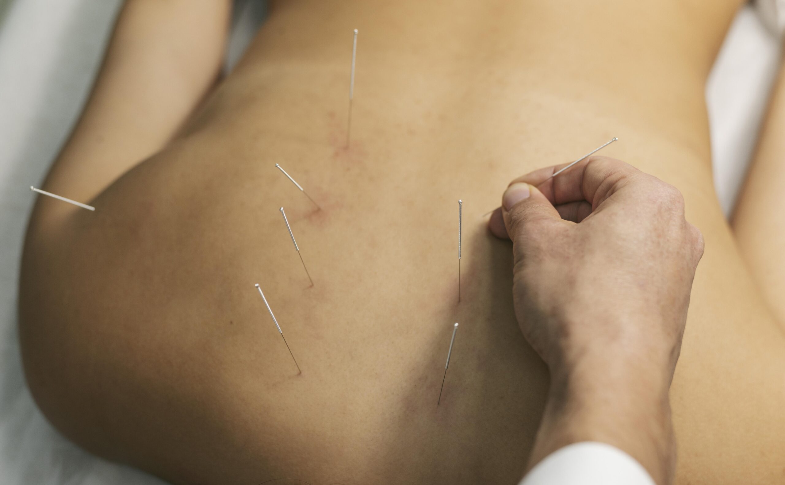 acupuntura1